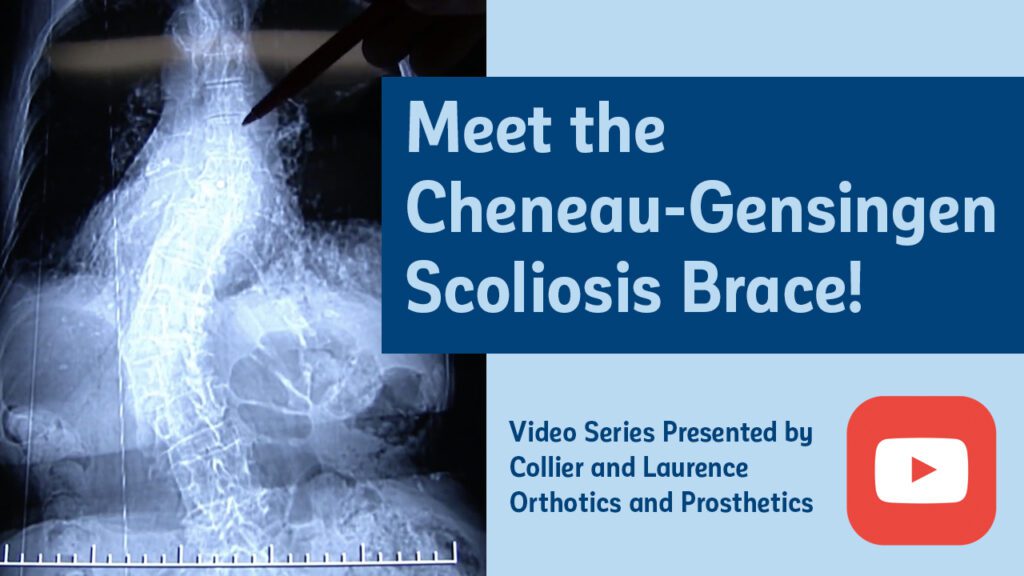 video thumbnail: Meet the cheneau-gensingen scoliosis brace